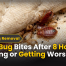 Bed Bug Bites After 8 Hours Fading or Getting Worse?