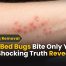 Why Bed Bugs Bite Only You: The Shocking Truth Revealed Complete Guide for CT Homeowners 9 Why Bed Bugs Bite Only You? The Shocking Truth Revealed